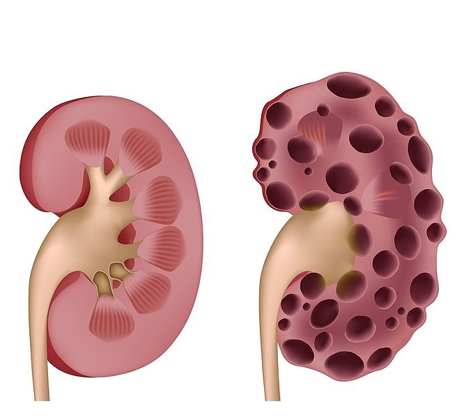 Kidney Ailments